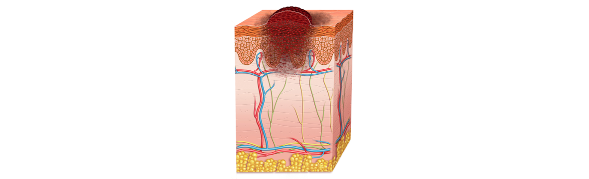 cáncer de piel melanoma