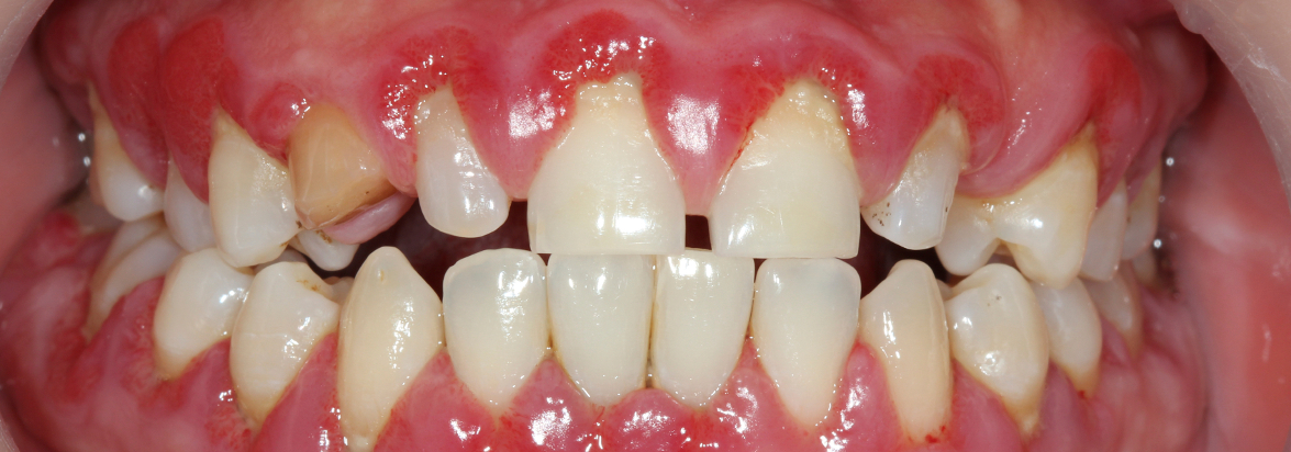gingivitis gingivitis