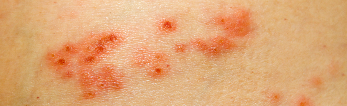 herpes genital herpes genital