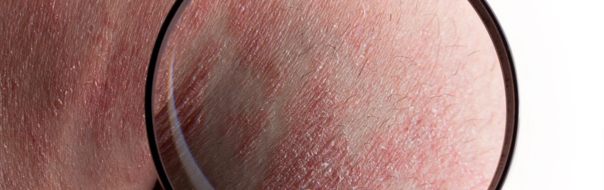 psoriasis