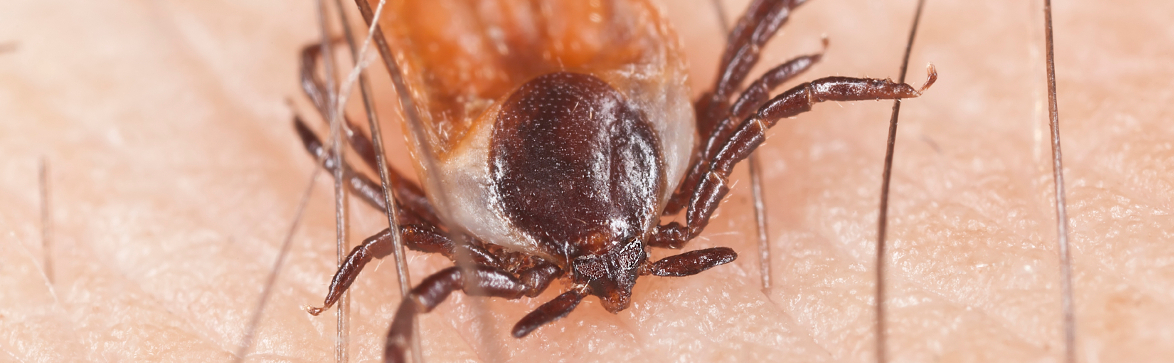 tularemia tularemia