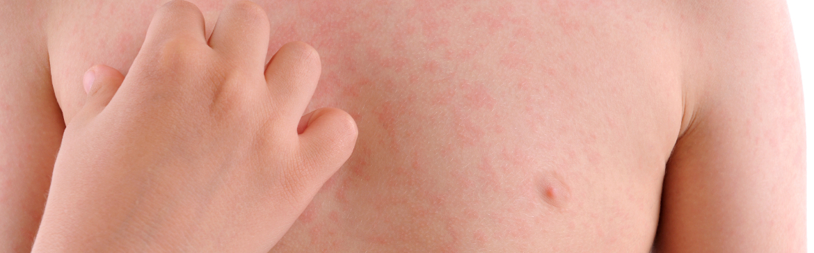urticaria urticaria