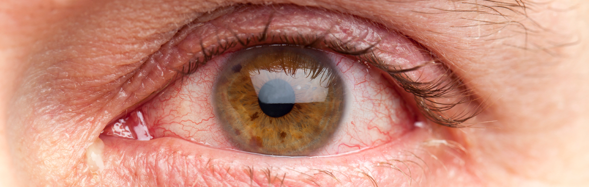 uveitis uveitis